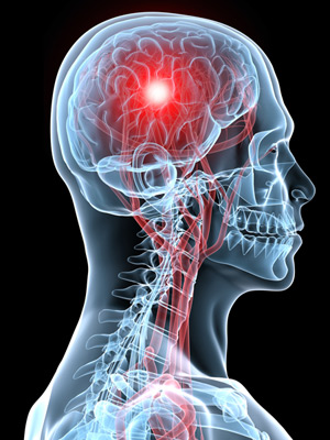 Illustrated x-ray of a human brain with concussion